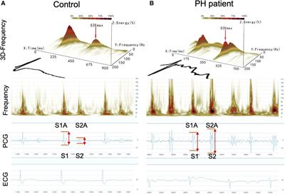 Noninvasive evaluation of pulmonary hypertension using the second heart sound parameters collected by a mobile cardiac acoustic monitoring system